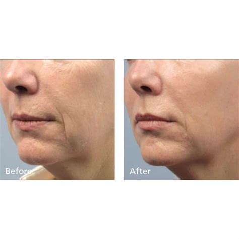 Skin Tightening Alpharetta GA .
